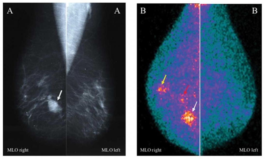 качественная маммосцинтиграфия 