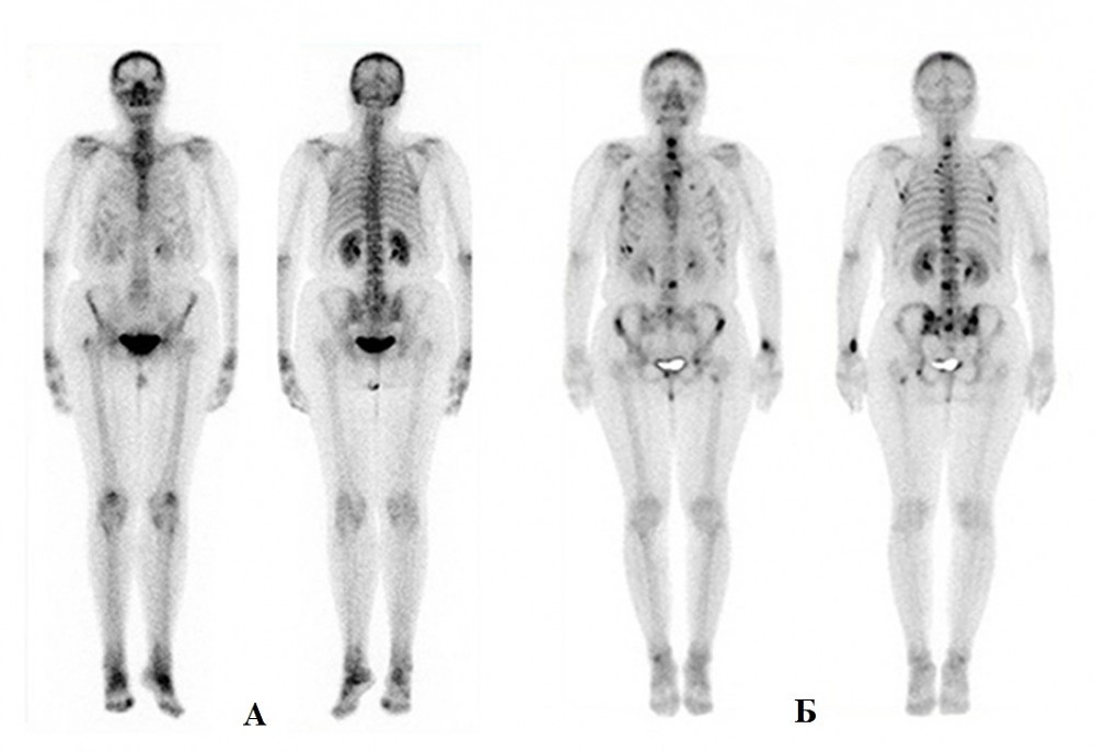 качественная сцинтиграфия костей скелета 