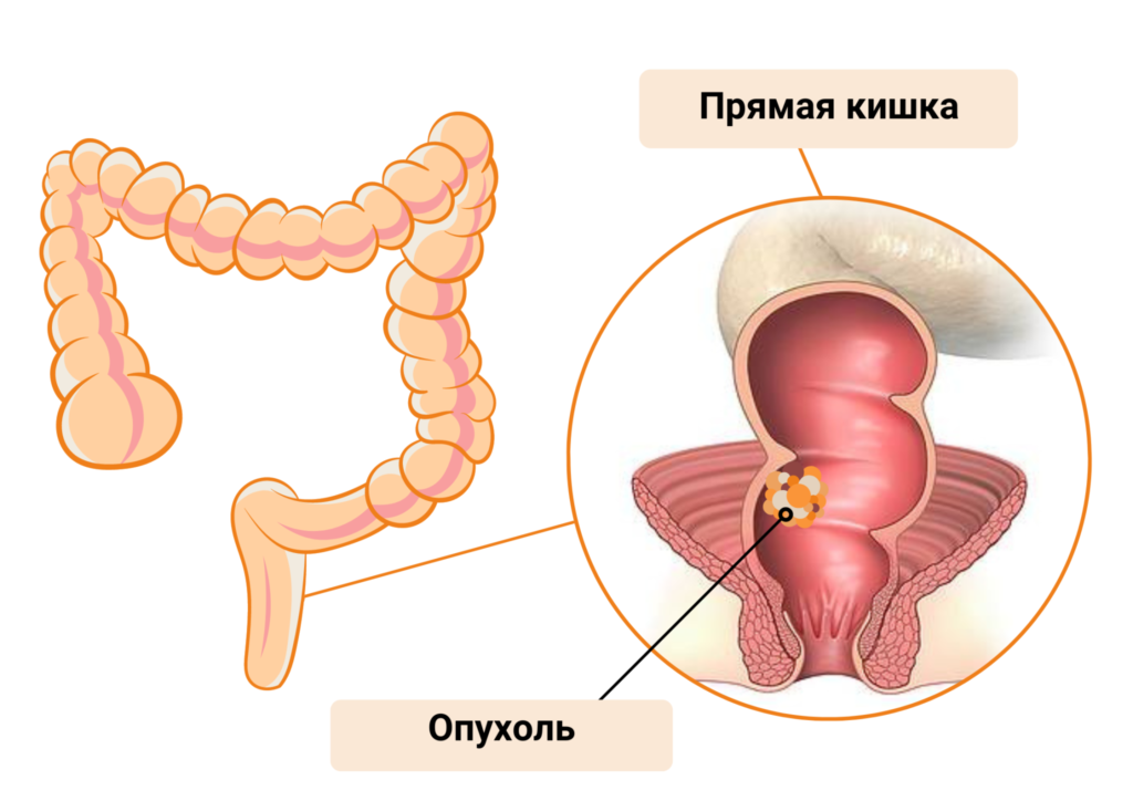 Рак ануса - причины, симптомы, диагностика и лечение, прогноз